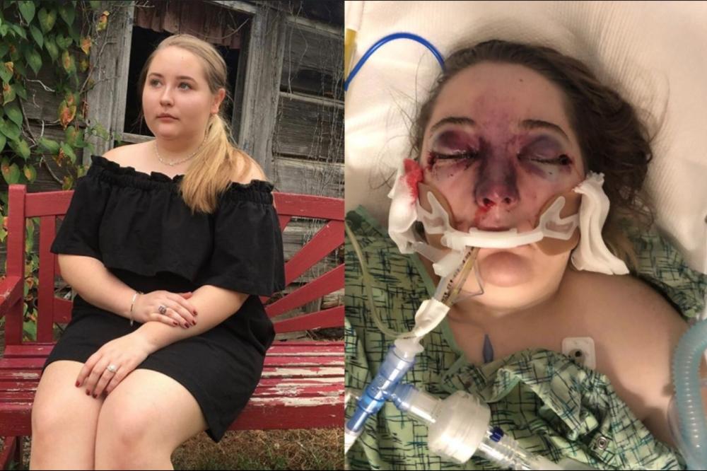 BILA JE SASVIM NORMALNA, A ONDA JE LICE POČELO DA JOJ OTIČE Oslepela je, a lekari PRVI PUT ČUJU za tu bolest (FOTO)