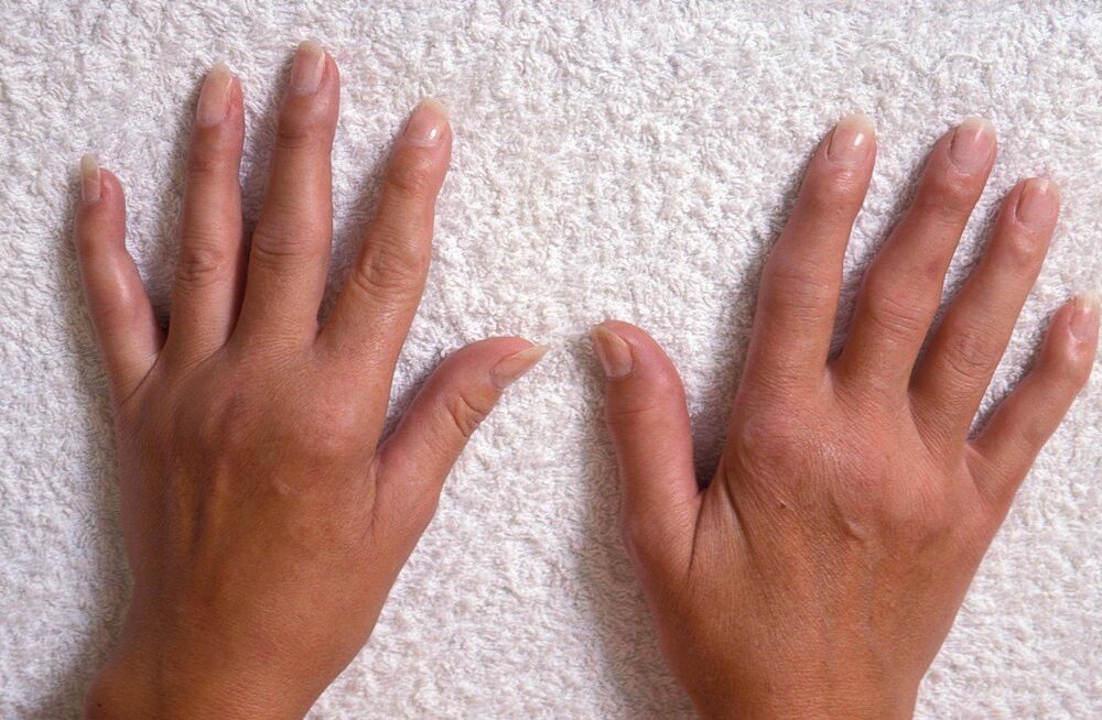 Oticanje prstiju, Prsti, Ruke
