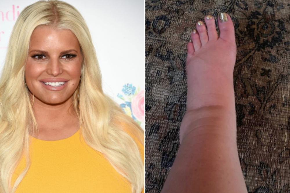 U POMOĆ! IMA LI OVOME LEKA?! Očajna pevačica se požalila na problem koji ima! Njena stopala su POTPUNO IZOBLIČENA!