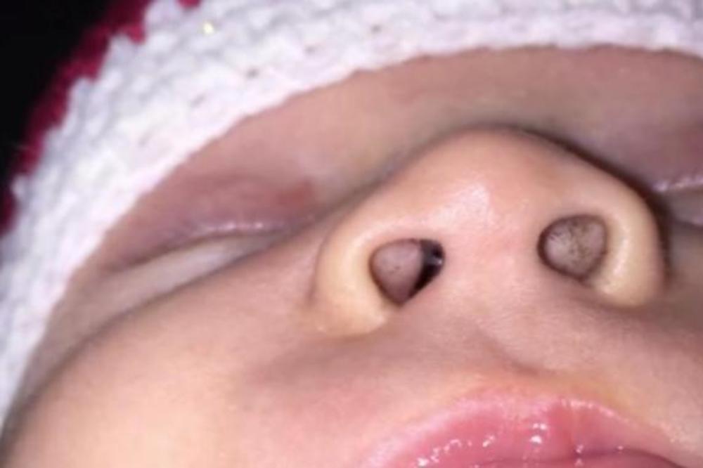 MAJKA JE PRIMETILA NEŠTO NEOBIČNO U BEBINOM NOSU: Kada je shvatila šta je, odmah je pozvala doktore! (VIDEO)