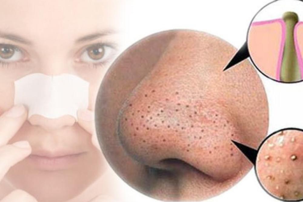 RUŽNI MITISERI NA NOSU SU PROŠLOST: Rešite ih se samo JEDNOM NAMIRNICOM iz kuhinje!