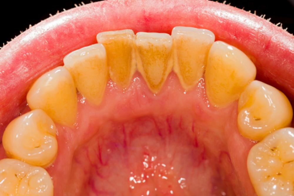 Ne možete ukloniti zubni kamenac preparatima iz kuće