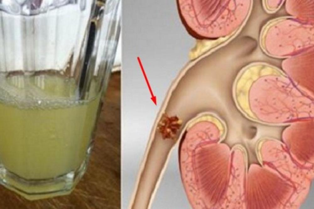 DOVOLJNO JE DA POPIJETE SAMO POLA ČAŠE OVOG NAPITKA: Recite zbogom KAMENU U BUBREGU! (RECEPT)