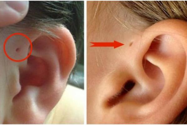 SAMO JEDINSTVENI LJUDI IMAJU OVU RUPICU PORED UHA: Razlog je veoma ZANIMLJIV!