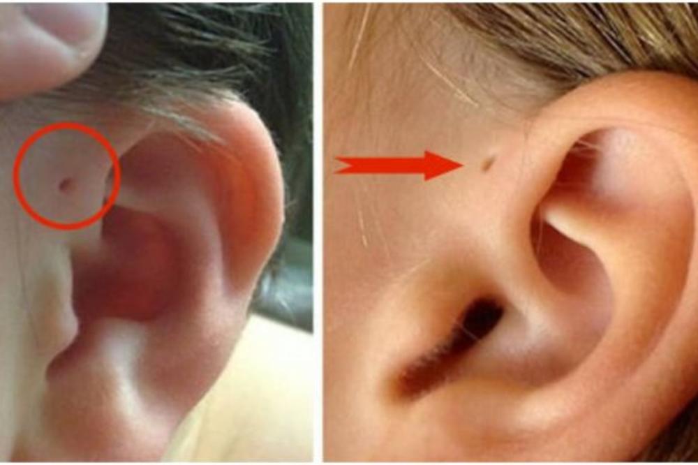 SAMO JEDINSTVENI LJUDI IMAJU OVU RUPICU PORED UHA: Razlog je veoma ZANIMLJIV!