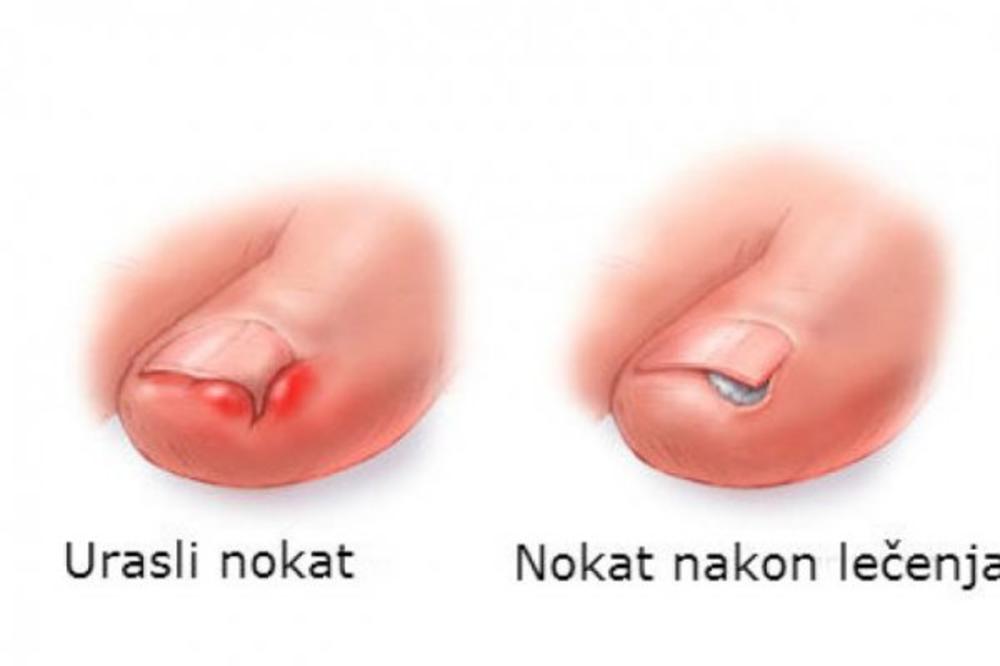 NE MORATE KOD LEKARA: Evo kako da izvadite URASLI NOKAT uz pomoć samo OVE 2 STVARI!