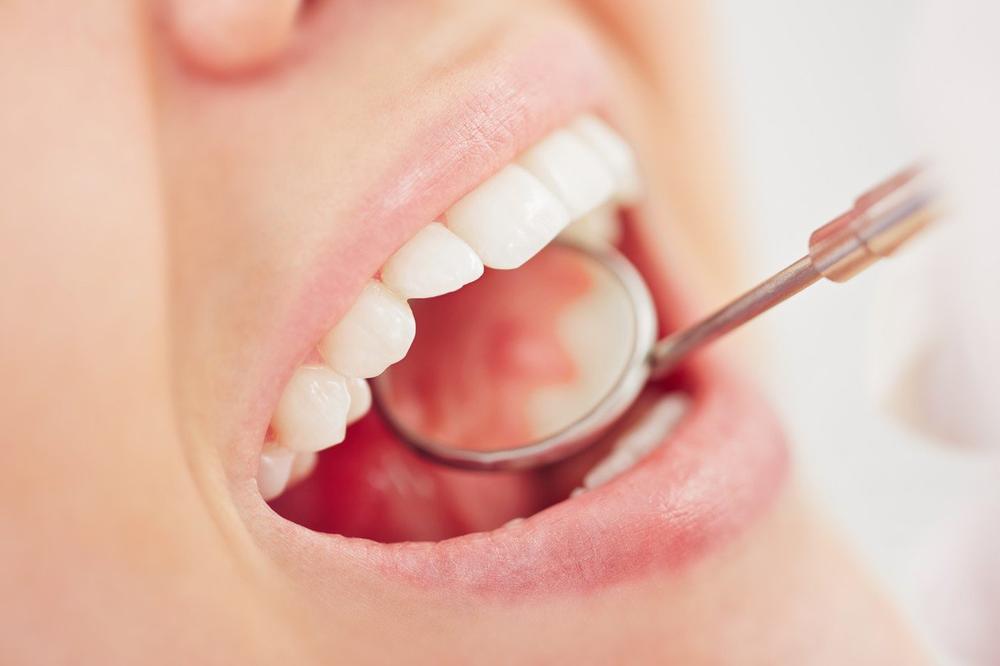 UKLONITE ZUBNI PLAK BEZ POSETE STOMATOLOGU: Ovo su PRIRODNI NAČINI da sačuvate zube!