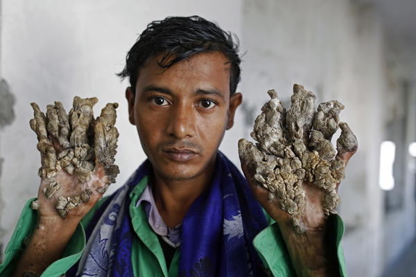 ZBOG UŽASNE BOLESTI ZOVU GA ČOVEK DRVO! Ono što mu raste po rukama i nogama teško je gledati, a sada je u OPASNOSTI