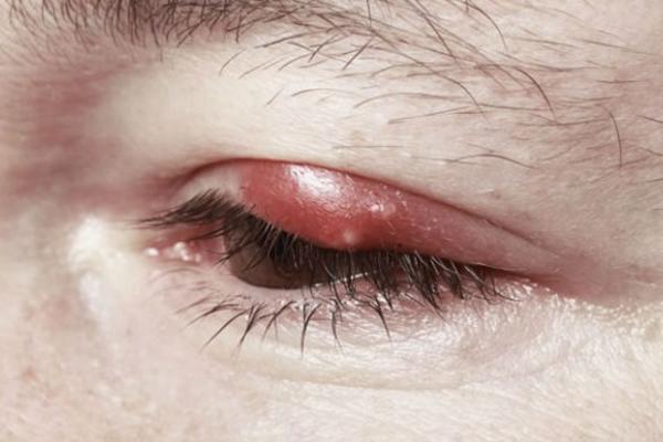 ČMIČAK NA OKU: Ružno izgleda i iritira, ali koliko god da vas nervira, NEMOJTE DA RADITE JEDNU STVAR!