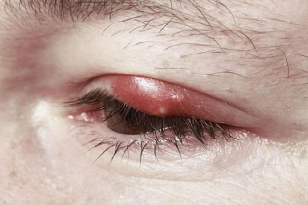 ČMIČAK NA OKU: Ružno izgleda i iritira, ali koliko god da vas nervira, NEMOJTE DA RADITE JEDNU STVAR!