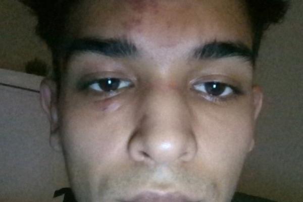 DOBIO SAM BATINE ZATO ŠTO SAM CIGANIN! Mladi pretučeni Rom objavio sliku MODRICA s jednom JASNOM PORUKOM (FOTO)