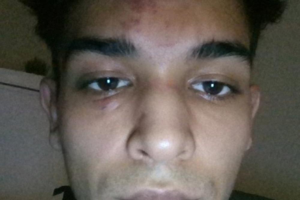 DOBIO SAM BATINE ZATO ŠTO SAM CIGANIN! Mladi pretučeni Rom objavio sliku MODRICA s jednom JASNOM PORUKOM (FOTO)