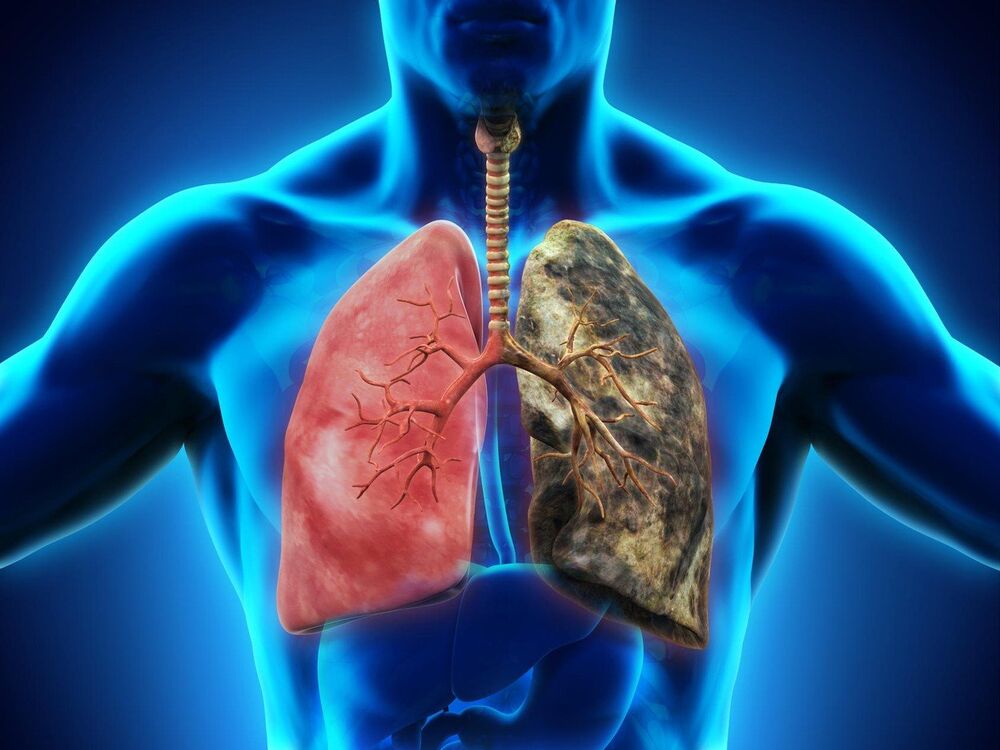 Rak pluća se javlja kod približno 30 posto nepušača i mladih ljudi koji vode zdrav život  