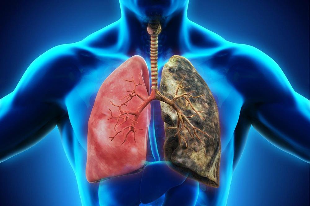 ALARMANTNI PODACI: Rak pluća svakog dana odnese 13 života