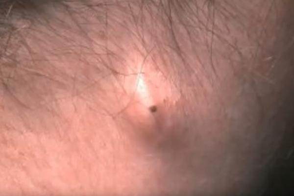 NIPOŠTO NE IGNORIŠITE OVU IZRASLINU IZA UHA: Ona ukazuje na nešto što bi vam moglo stvoriti PAKAO OD ŽIVOTA!