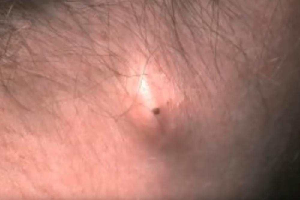 NIPOŠTO NE IGNORIŠITE OVU IZRASLINU IZA UHA: Ona ukazuje na nešto što bi vam moglo stvoriti PAKAO OD ŽIVOTA!