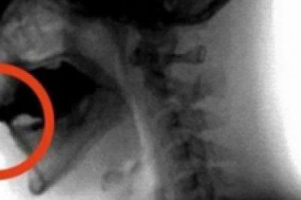OVAJ OTROV UNIŠTAVA VAŠE KOSTI: Ipak, milioni ljudi ga konzumira barem jednom dnevno! UŽAS!