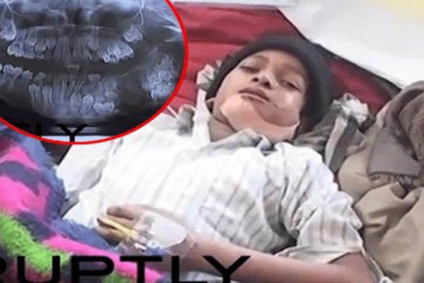 DEČAKU (7) SU IZVADILI 80 ZUBA: Lekari su izveli neviđenu operaciju koja je trajala četiri sata! (VIDEO)