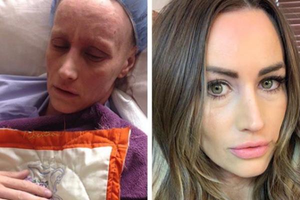 ZBOG SILIKONA JOJ JE OTPALA KOSA, SMRŠALA JE 20 KG: Horor priča devojke, bila je sigurna da UMIRE! (FOTO)