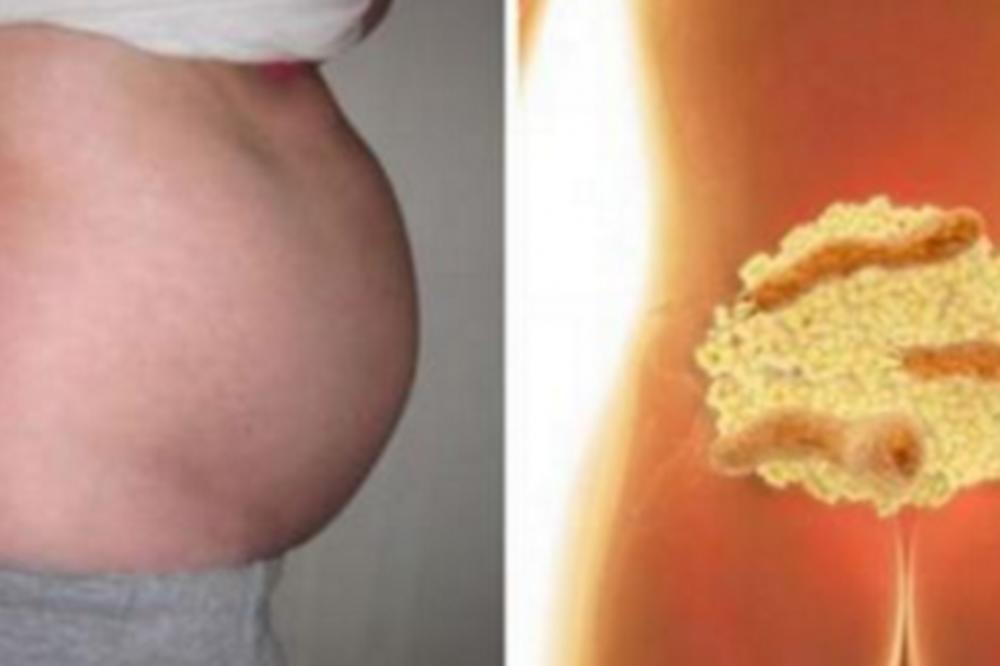 UZROK NADUTOSTI NIJE UVEK HRANA ILI PMS: Nije nimalo bezazleno, ODMAH trk kod lekara