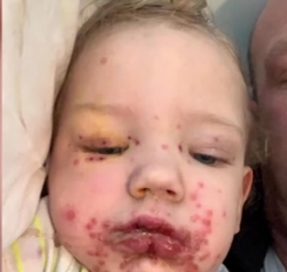 Ispostavilo se da mali Kalo ima virus herpes simpleks