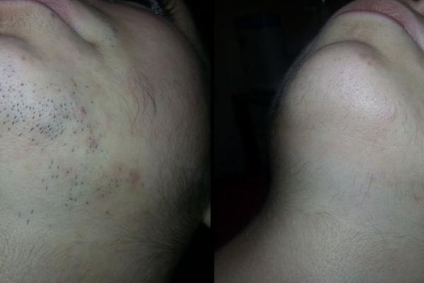 AKO IMATE PROBLEMA S DLAKAMA NA LICU, POSTOJI REŠENJE: Evo kako da ih uklonite POTPUNO PRIRODNO u svom domu!