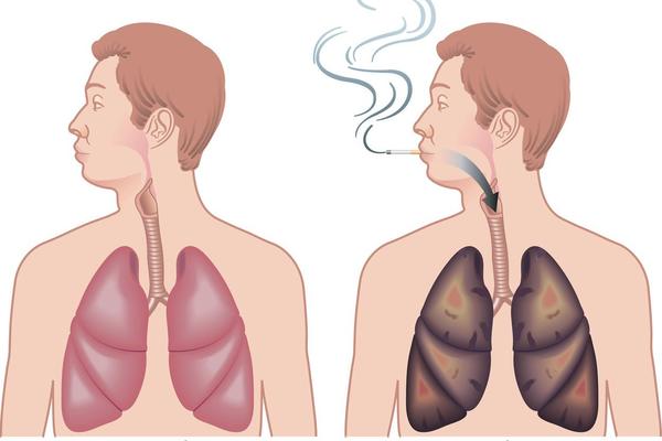POZNATO JE DA JE PUŠENJE JAKO ŠTETNO: Znate li da IZAZIVA i ovu OPAKU BOLEST?