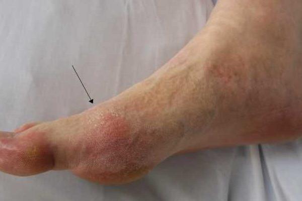 OVO SU ZNAKOVI DA VAM ŠEĆER RAZARA ORGANIZAM: Nikako NE IGNORIŠITE OVE STVARI!