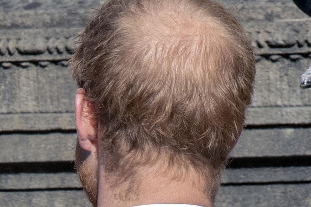 LEKARI OTKRILI ŠTA NE SMETE DA RADITE AKO VAM OPADA KOSA: Neće biti SVEJEDNO KADA OVO ČUJETE