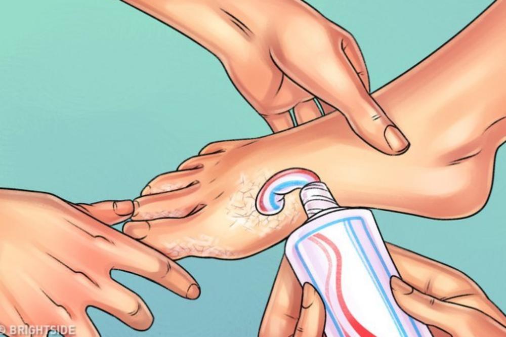 ONA JE PASTU ZA ZUBE STAVILA NA SVOJA STOPALA: Kada vidite šta joj se desilo i vi ćete uraditi ISTO