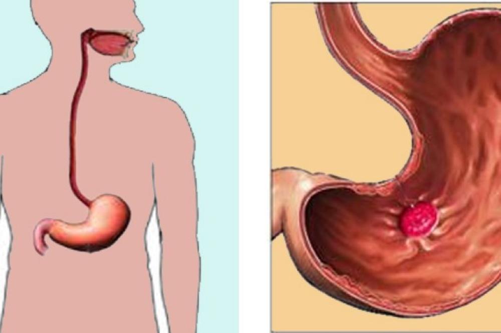 SPREČITE DA VAM PUKNE ČIR NA ŽELUCU: Uz pomoć ovih 7 PRIRODNIH LEKOVA to vam se NEĆE DESITI!