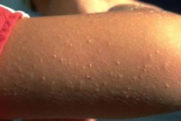 SVAKA DRUGA OSOBA BOLUJE OD OVOGA: Ako vam je koža nadlaktice HRAPAVA, ovaj sastojak u HRANI VAM SMETA