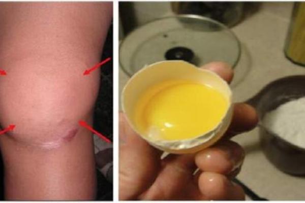 KOMBINACIJA JAJA I SOLI NE LEČI BOL U KOLENU: Ovo je prava istina