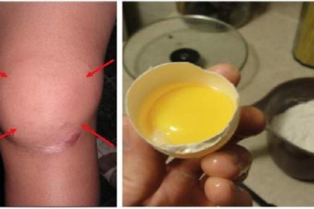 KOMBINACIJA JAJA I SOLI NE LEČI BOL U KOLENU: Ovo je prava istina