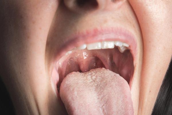 PRVI ZNAK TEŠKOG OBOLJENJA: Ukoliko osetite PROMENE na svom jeziku, odmah idite kod lekara!