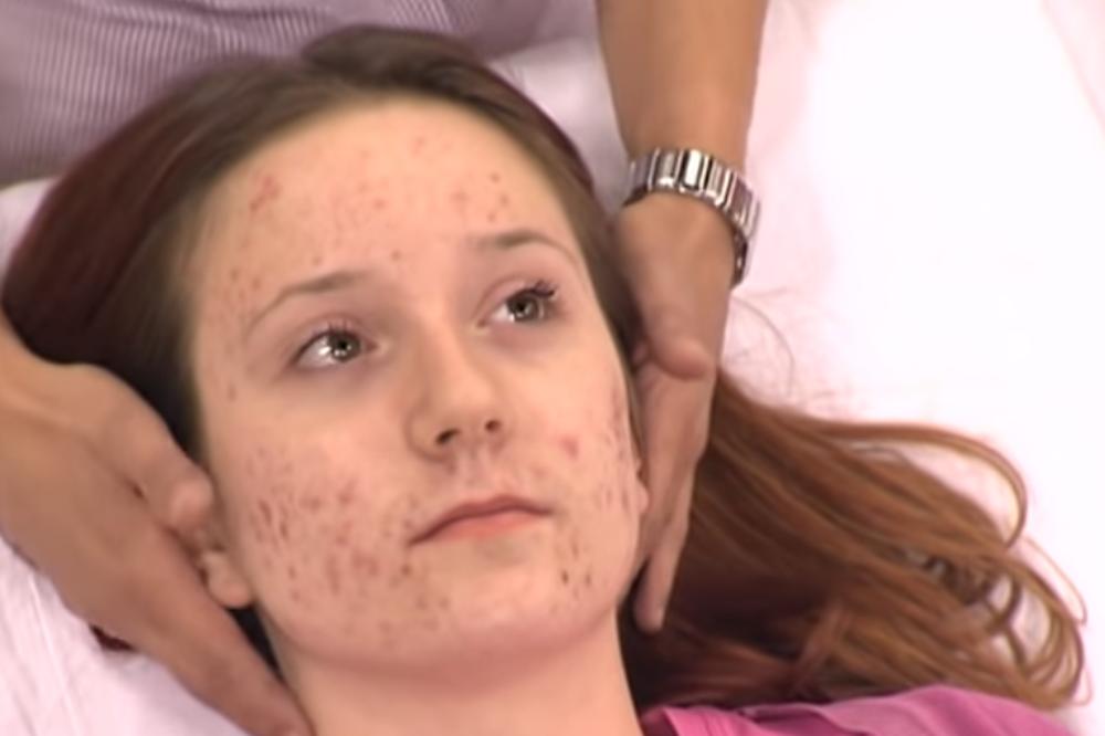 RECITE ZBOGOM BUBULJICAMA: Iscedite OVAJ SOK i nanesite na problematičnu kožu, rezultat će vas ODUŠEVITI! (RECEPT)