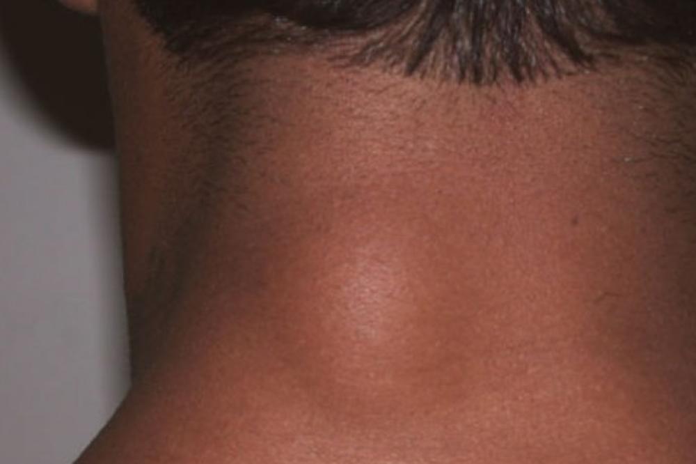 NEMA DOKAZA DA JE MEŠAVINA BRAŠNA I MEDA LEK ZA MASNO TKIVO