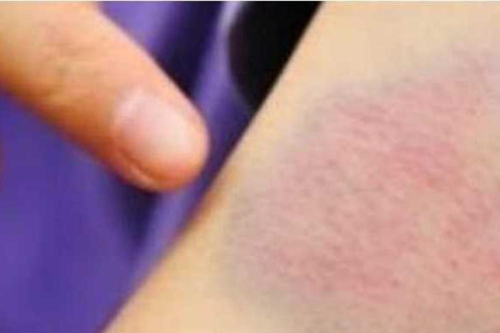 LISTA MANJE POZNATIH STVARI KOJE BI MOGLE BITI SIMPTOMI RAKA: Ukoliko vam se dešava nešto od OVOG, PREGLEDAJTE SE!