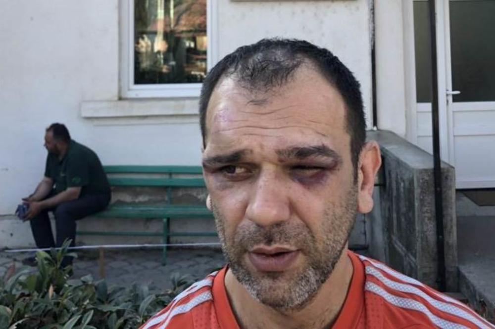 OVO JE MUŠKARAC KOJI TVRDI DA JE PRETUČEN U KABINETU PREDSEDNIKA OPŠTINE: Ima HEMATOM veličine ORAHA