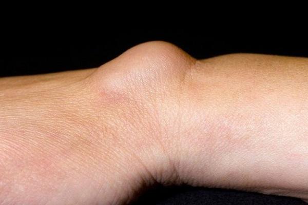 MNOGI LJUDI PATE OD OVOGA, A NI NE ZNAJU O ČEMU SE RADI: Pogledajte da li i vi imate OVU STVAR na zglobu ruke!