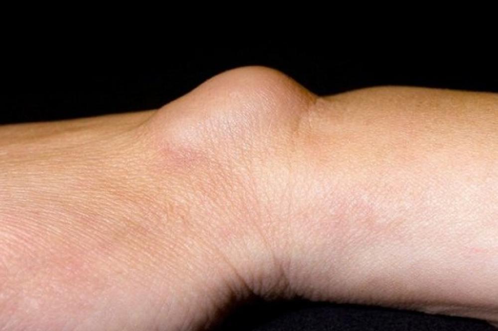 MNOGI LJUDI PATE OD OVOGA, A NI NE ZNAJU O ČEMU SE RADI: Pogledajte da li i vi imate OVU STVAR na zglobu ruke!