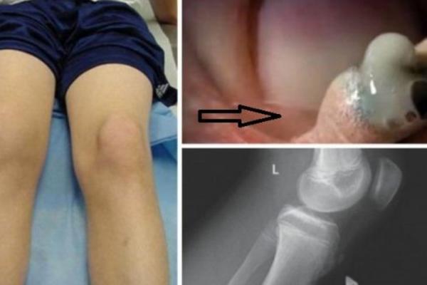 ODLUČILA JE DA SAMA ISTISNE RANU NA KOLENU SVOG SINA: Ali kada je OVO IZAŠLO, odmah je počela da VRIŠTI! (FOTO)