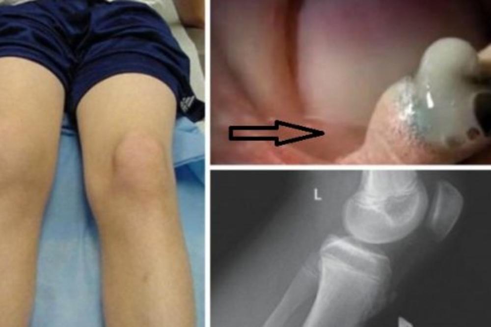 ODLUČILA JE DA SAMA ISTISNE RANU NA KOLENU SVOG SINA: Ali kada je OVO IZAŠLO, odmah je počela da VRIŠTI! (FOTO)