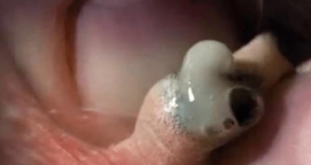 Našla je puža u rani na kolenu  