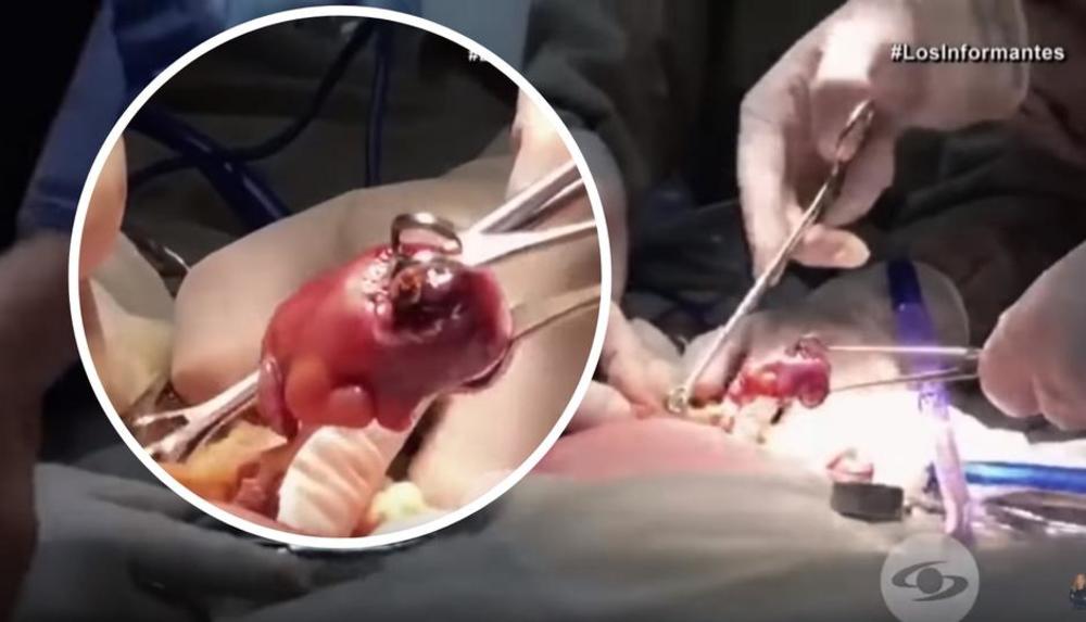 Iz bebe su izvadili bliznakinju 