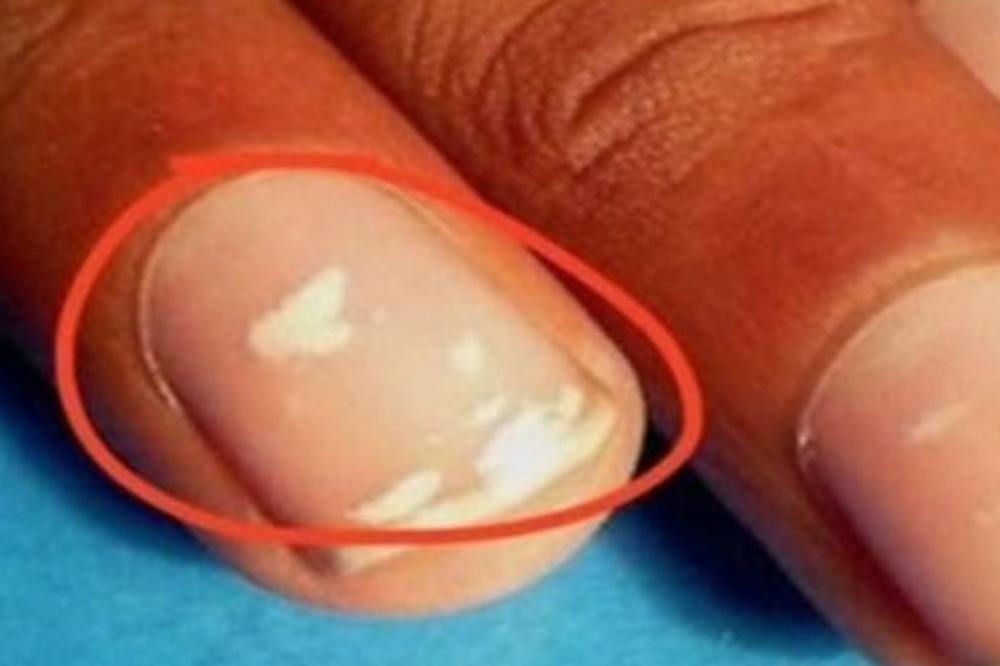 NOKTI SU POKAZATELJ I NAJTEŽIH BOLESTI: Ako vidite ove promene, možda imate neko OBOLJENJE!