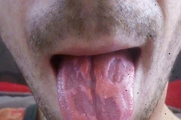 BOJA JEZIKA GOVORI O VAŠEM ZDRAVLJU VIŠE NEGO ZDRAVSTVENI KARTON: Ako primetite ovu PORMENU otmah trčite LEKARU