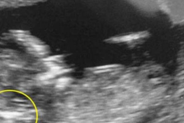 Kad je ginekolog video OVAJ DETALJ na ultrazvuku, rekao mi je da ŠTO PRE ABORTIRAM: Rodila sam i ostala u ŠOKU