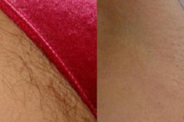 REŠITE SE NEŽELJENIH DLAČICA ZAUVEK: Genijalan trik sa ORASIMA koji čini čuda! ŽENE, OVO MORATE ZNATI! (RECEPT)