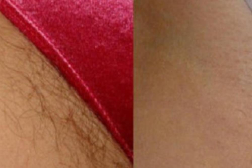 REŠITE SE NEŽELJENIH DLAČICA ZAUVEK: Genijalan trik sa ORASIMA koji čini čuda! ŽENE, OVO MORATE ZNATI! (RECEPT)